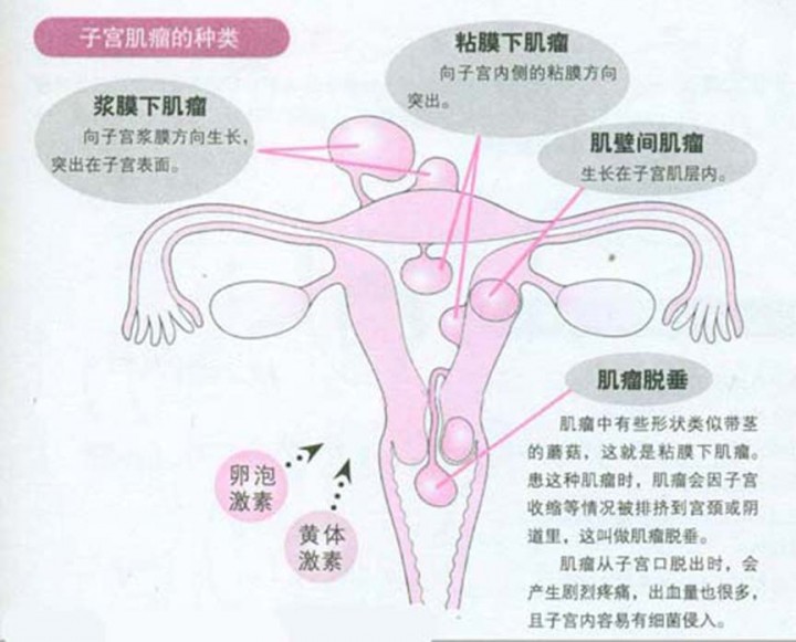 爱吃冰?准备你的子宫肌瘤变大吧!