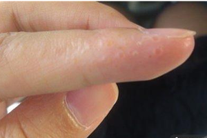 檢查看看，你的掌心或手指側面也會長出「西米露」嗎？竟然是這種疾病，真的不能輕忽啊！