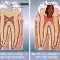 補牙過後，牙齒還是感到疼痛是怎麼回事？