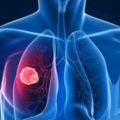 7個「可以讓你盡早發現然後趕快進行治療」的肺癌徵兆！