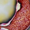 夫妻相繼得胃癌到底吃了些啥？如何有效預防胃癌應該注意些什麼？