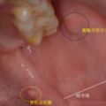 男孩得了「口腔癌」寶爸很後悔說：不該讓孩子吃！