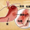 胃不舒服怎麼辦？慢性胃炎和胃痛的飲食建議有哪些？