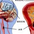 中風後，很多人反復鍛煉無效果，很多人又第二次中風是怎麼回事？中風沒幾個長壽的，為什麼？