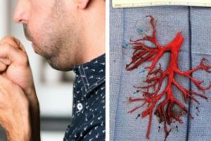 男子咳出「支氣管樹」血塊　一周後因心臟衰竭併發症辭世