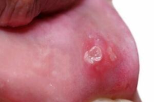 口腔潰瘍總是反復，需警惕5種疾病，別不當回事