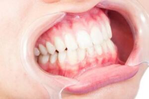 牙齦出血是牙齦發炎了嗎？這幾件事，都會讓你患上牙齦炎
