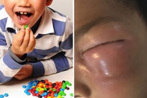 泰3歲男童「懶惰刷牙」下場超慘　牙醫PO照：牙齒全蛀、菌跑去眼睛