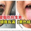 驚！婦受傷吃抗生素舌頭竟長滿「黑色絨毛」