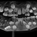 7歲男孩下顎長出「詭異肉包」　醫生一劃…驚見「526顆密集牙齒」