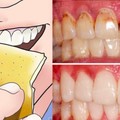 不用洗牙！六個方法就能去除牙菌斑！再也不怕洗牙痛痛了