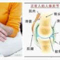 關節炎應拒吃8大類食物,小心越吃越痛、發炎惡化,加速關節變形!