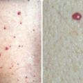皮膚上突然長出「紅痣」，是衰老特徵，還是皮膚腫瘤？快聽聽醫生的說法！