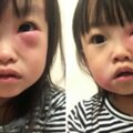 2歲萌妹被蚊子偷咬「隔天腫成一條線」　其他家長曬照：我家的更慘…