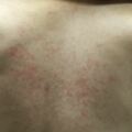 背部反覆出現紅疹　28歲男竟罹淋巴癌，醫生，皮膚出現反覆、長久不消紅疹要小心