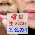 有一種說不出的痛叫做生ulcer？教你6招擊退嘴巴ulcer！