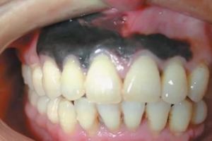 牙齒上出現這種症狀，你就要小心腫瘤了！就會隨著血流向肺部、肝髒、骨骼、腦部等器官轉移