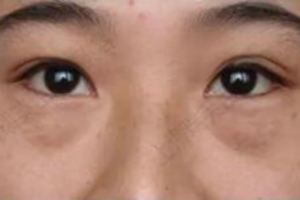 女人有眼袋別打玻尿酸！教你幾招最有效去眼袋方法，甩掉眼睛浮腫
