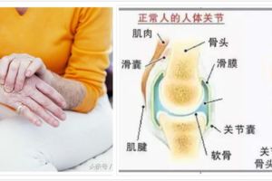 關節炎應拒吃8大類食物,小心越吃越痛、發炎惡化,加速關節變形!
