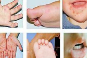 新型手足口病出現，已經有孩子中招（寶媽收藏警惕），貽誤治療的最佳時期
