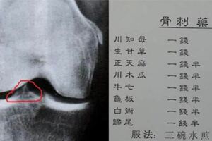 【骨刺藥方】大公開！只喝了4天，就沒有痛了！無需找醫生開刀！