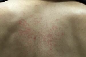 背部反覆出現紅疹　28歲男竟罹淋巴癌，醫生，皮膚出現反覆、長久不消紅疹要小心