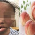 10歲女童咬了一口桃子嘴唇腫得像香腸(圖)
