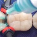 蛀牙救星！科學家開發出「補牙凝膠」　「48小時內」再生琺瑯質