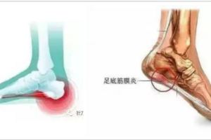 足跟痛疾病？診斷與治療要點