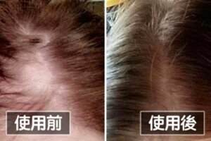 「神奇生髮洗髮精」在Amazon狂獲5星評價！　使用者淚PO對比照：真的長出來了～