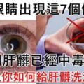 要小心！當眼睛出現這7個信號，說明肝臟已經「中毒太深」，中醫教你如何「幫肝臟洗澡排毒」！