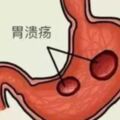 胃潰瘍是怎麼形成的？5大常見早期癥狀你應了解！