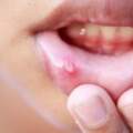 舌頭上這種現象，以為是口腔潰瘍？醫生提醒：幸好癌細胞沒擴散