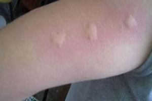 教你3個止癢絕招，【被蚊子咬後】一分鐘止癢不留印痕