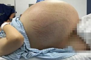 新婚人妻頂著巨大肚子身懷32公斤「怪胎」，手術取出的東西嚇壞了所有醫生！！