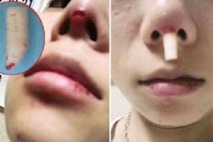 好恐怖阿！一少女擠壓鼻子痘痘時，竟擠出這樣的東西....還穿出了一個洞！