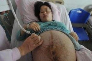 四胞胎孕媽38周遲遲不生，婆婆跪求阻止手術，剖開肚子醫生絕望搖頭！