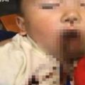 筷子插進嘴巴眼眶1歲半童滿臉鮮血