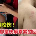 1歲多孩子送托嬰中心照顧全身多處竟慘遭大口咬傷