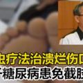 蛆蟲療法治潰爛傷口　5千糖尿病患免截肢