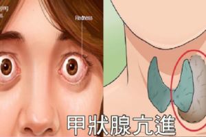 眼凸、怕熱、緊張失眠？當心「甲狀腺亢進」已鎖定你！遵循「四吃四不吃」讓甲狀腺重回平衡。