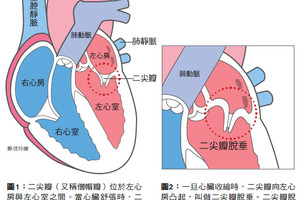 什麼是二尖瓣脫垂? 請仔細下列幾點