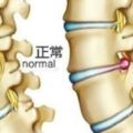 大棗加大蔥竟是腰椎間盤突出的終結者，治一好一，腰不好不要錯過