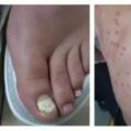 癬病是完全可以「根」治的。牛皮癬、、桃花癬？、香港腳、灰指甲？癬到底是啥？