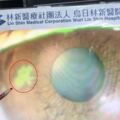 揉眼導致視力剩「0.5」，醫生診斷破皮導致病毒入侵，嚴重恐失明！