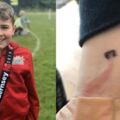 英國8歲男孩手腕現紅斑，機警媽媽意識到不妙，救下兒子一命
