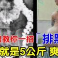 [老中醫]教你一招排黑便！一次排5公斤，排便一次到底