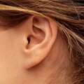 耳朵上這個不起眼的小洞可能是病？快檢查你家寶寶，早發現