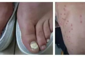 癬病是完全可以「根」治的。牛皮癬、、桃花癬？、香港腳、灰指甲？癬到底是啥？