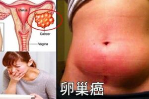 「卵巢癌」易與「胃脹氣」混淆！腹部有這些癥狀的人一定要立馬預約醫生檢查！!